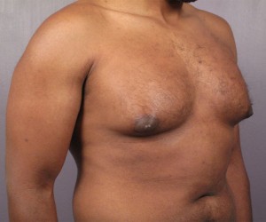 Male Breast Reduction Before and After