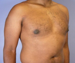 Male Breast Reduction Before and After