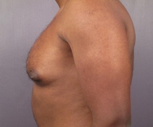 Male Breast Reduction Before and After