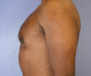 Male Breast Reduction Before and After