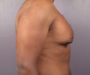 Male Breast Reduction Before and After