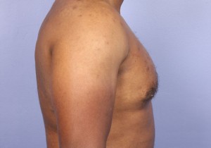 Male Breast Reduction Before and After