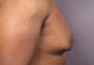 Male Breast Reduction Before and After