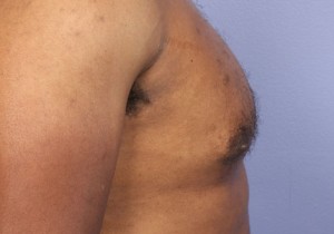 Male Breast Reduction Before and After