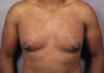 Male Breast Reduction Before and After Photo