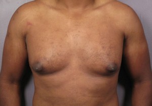 Male Breast Reduction Before and After