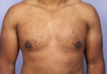Male Breast Reduction Before and After Photo