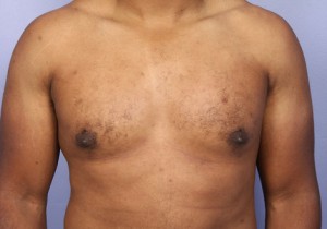 Male Breast Reduction Before and After