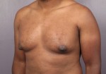 Male Breast Reduction Before and After Photo