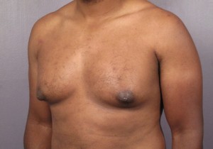 Male Breast Reduction Before and After