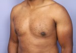 Male Breast Reduction Before and After Photo