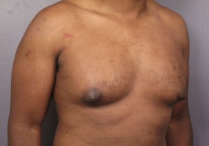 Male Breast Reduction Before and After