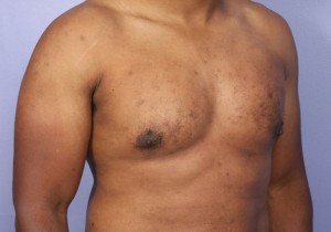 Male Breast Reduction Before and After