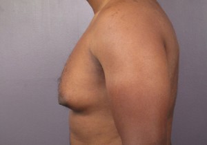 Male Breast Reduction Before and After