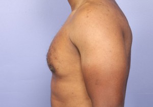 Male Breast Reduction Before and After