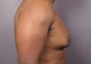 Male Breast Reduction Before and After