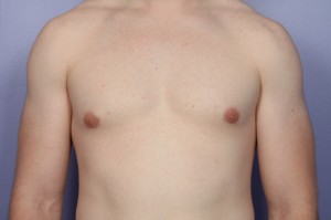 Male Breast Reduction Before and After