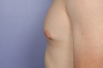 Male Breast Reduction Before and After Photo