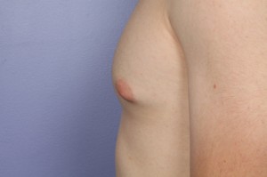 Male Breast Reduction Before and After