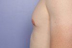 Male Breast Reduction Before and After Photo