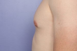 Male Breast Reduction Before and After