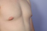 Male Breast Reduction Before and After Photo