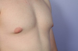 Male Breast Reduction Before and After