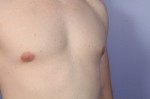 Male Breast Reduction Before and After Photo