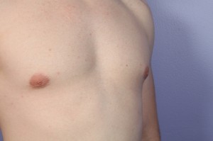 Male Breast Reduction Before and After