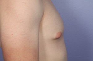 Male Breast Reduction Before and After