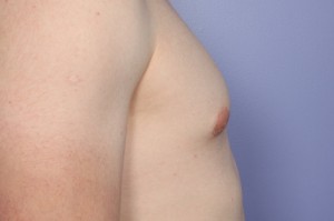 Male Breast Reduction Before and After