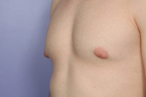 Male Breast Reduction Before and After