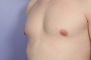 Male Breast Reduction Before and After