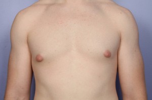 Male Breast Reduction Before and After