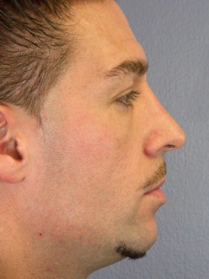 Rhinoplasty Before and After