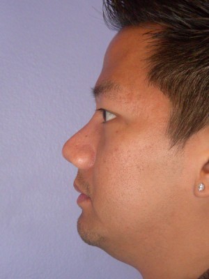 Rhinoplasty Before and After