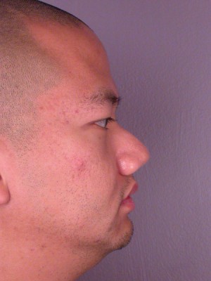 Rhinoplasty Before and After