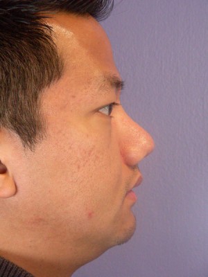 Rhinoplasty Before and After