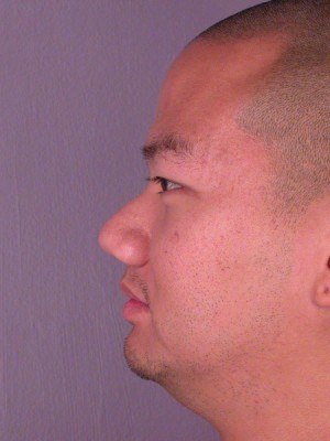 Rhinoplasty Before and After