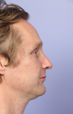 Rhinoplasty Before and After