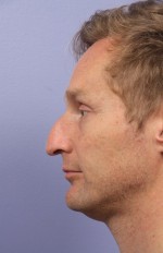 Rhinoplasty Before and After Photo