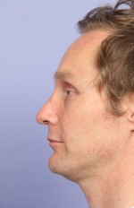 Rhinoplasty Before and After Photo