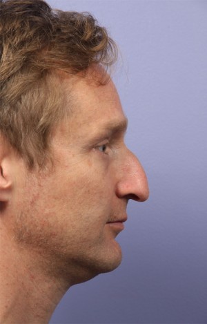 Rhinoplasty Before and After