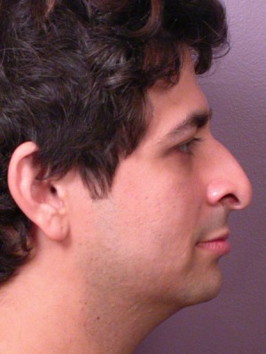 Rhinoplasty Before and After