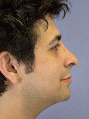 Rhinoplasty Before and After