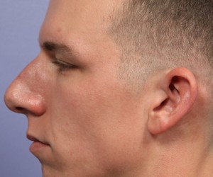 Rhinoplasty Before and After