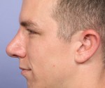 Rhinoplasty Before and After Photo