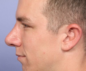 Rhinoplasty Before and After