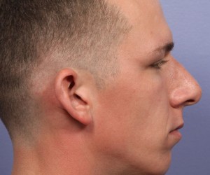 Rhinoplasty Before and After