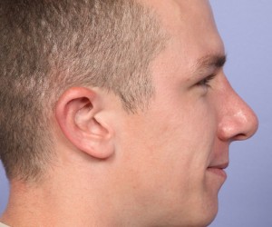 Rhinoplasty Before and After